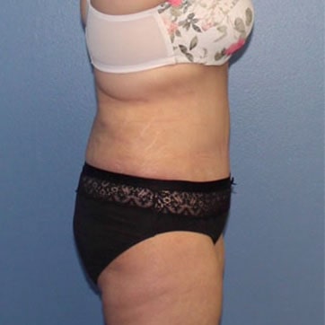 A side photo of a patient after tummy tuck.