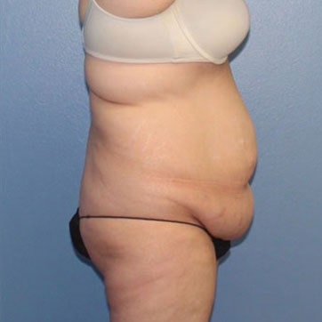 A side photo of a patient before tummy tuck.