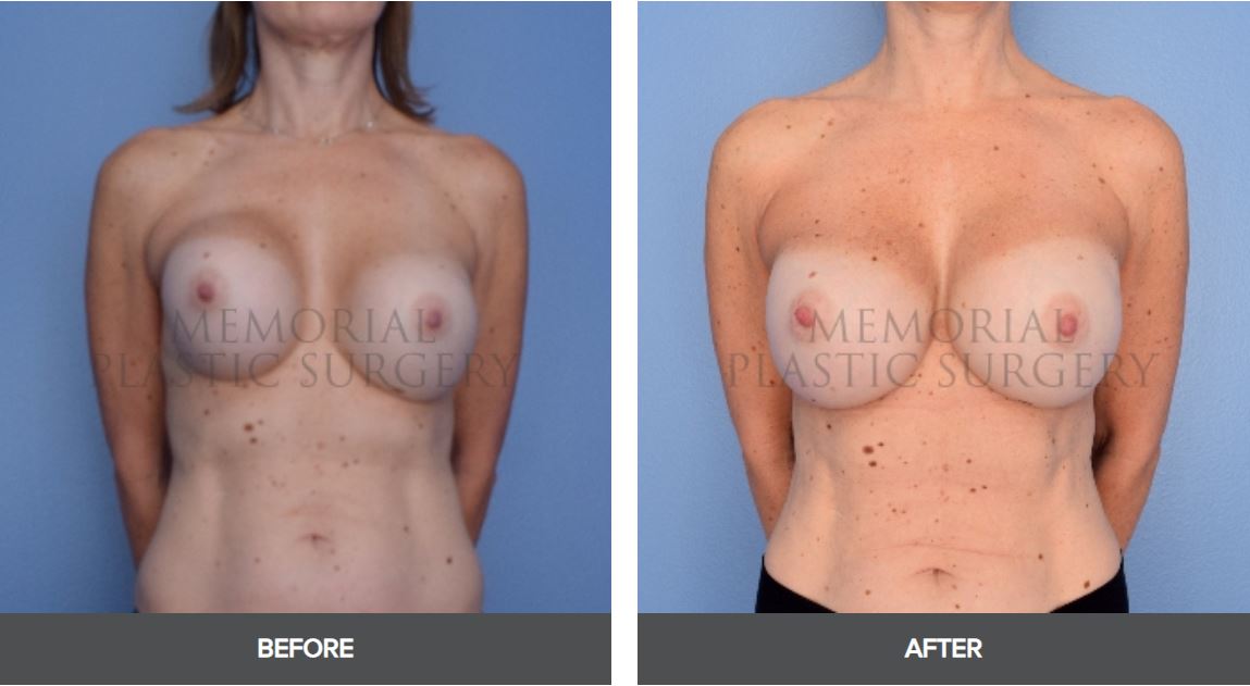 breast implant revision before and after