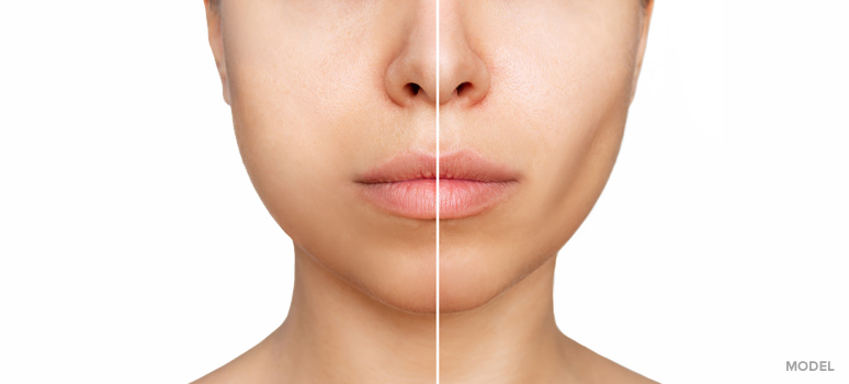 get contoured cheeks with buccal fat pad removal
